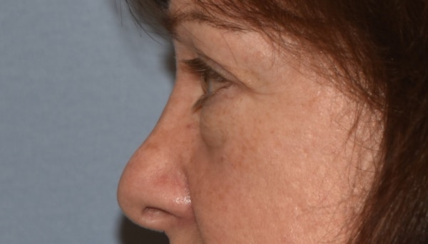 Eyelid Lift Before & After Gallery - Patient 142466208 - Image 5