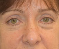 Eyelid Lift Before & After Gallery - Patient 142466208 - Image 1