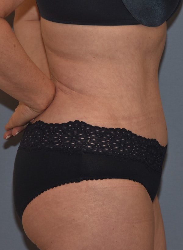Tummy Tuck Before & After Gallery - Patient 142465896 - Image 6