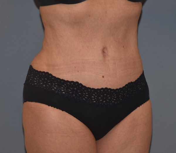 Tummy Tuck Before & After Gallery - Patient 142465896 - Image 4