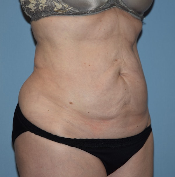 Tummy Tuck Before & After Gallery - Patient 142465896 - Image 3