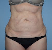 Tummy Tuck Before & After Gallery - Patient 142465896 - Image 1
