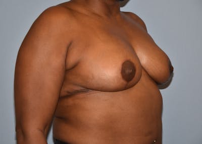 Breast Reduction Before & After Gallery - Patient 122906872 - Image 4