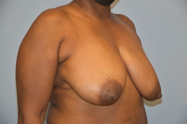 Breast Reduction Before & After Gallery - Patient 122906872 - Image 3