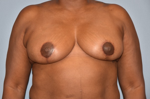 Breast Reduction Before & After Gallery - Patient 122906872 - Image 2