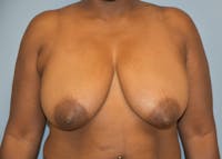 Breast Reduction Before & After Gallery - Patient 122906872 - Image 1