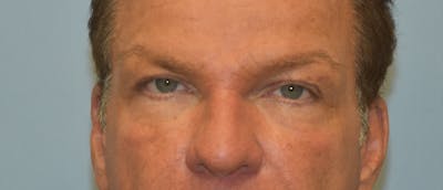 Eyelid Lift Before & After Gallery - Patient 122906503 - Image 1