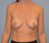 Breast Augmentation Before & After Gallery - Patient 122888914 - Image 1