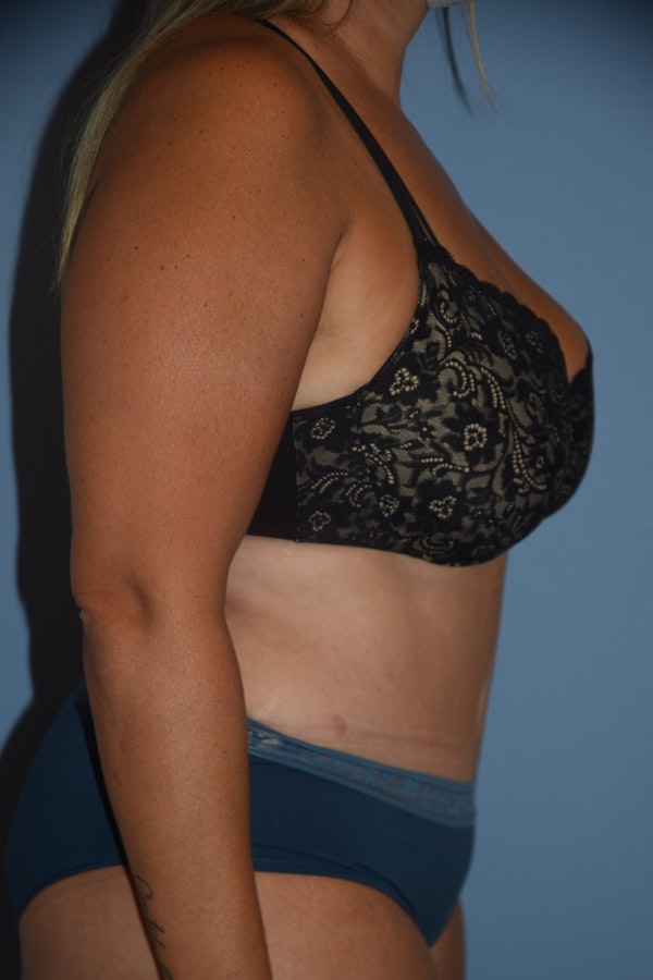 Tummy Tuck Before & After Gallery - Patient 122888577 - Image 6