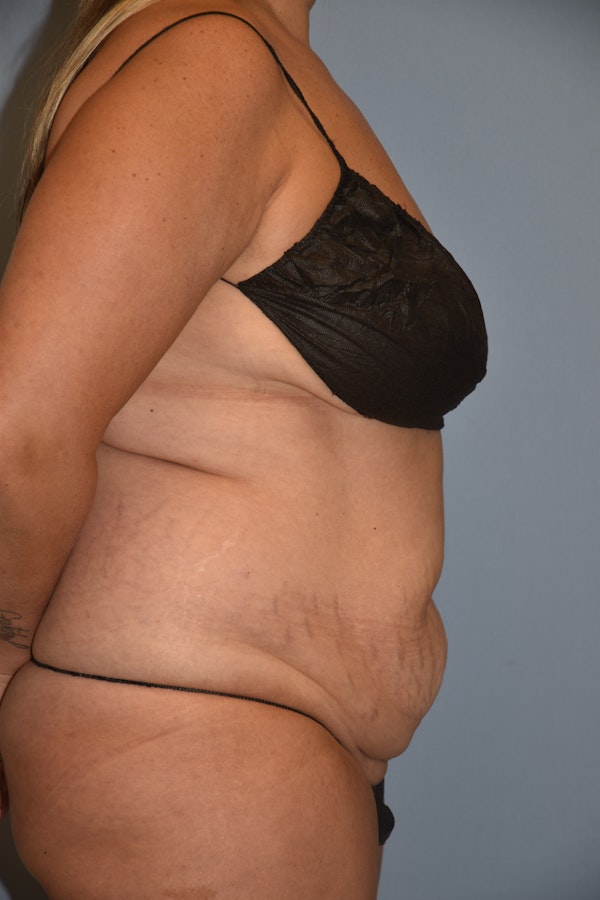 Tummy Tuck Before & After Gallery - Patient 122888577 - Image 5