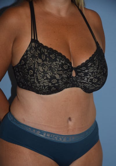 Tummy Tuck Before & After Gallery - Patient 122888577 - Image 4