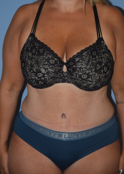 Tummy Tuck Before & After Gallery - Patient 122888577 - Image 2
