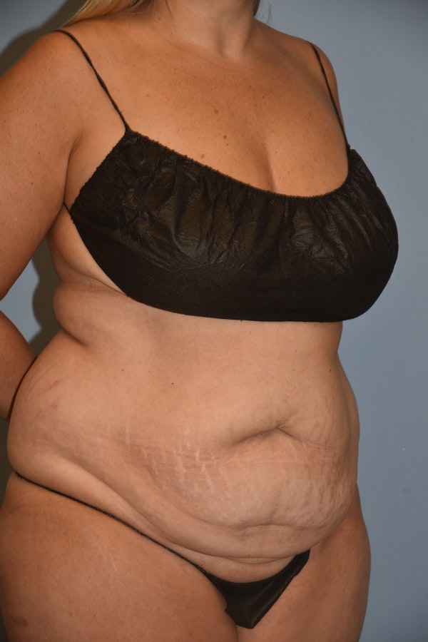 Tummy Tuck Before & After Gallery - Patient 122888577 - Image 3