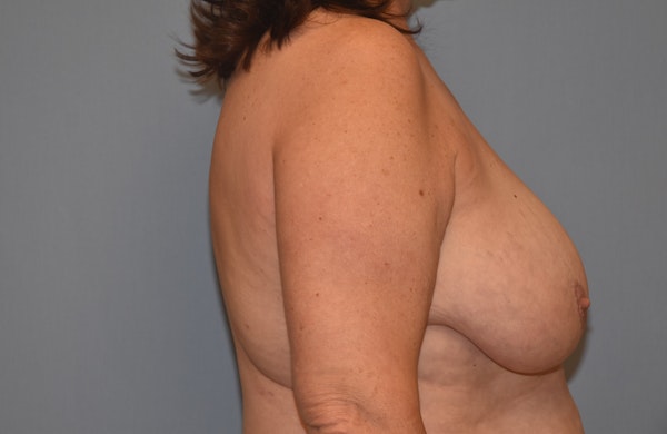 Breast Reduction Before & After Gallery - Patient 92167446 - Image 5