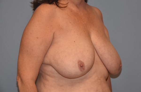 Breast Reduction Before & After Gallery - Patient 92167446 - Image 3