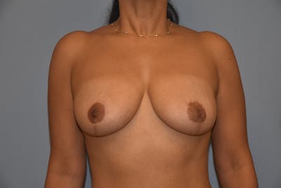 Breast Lift Before & After Gallery - Patient 92168028 - Image 2