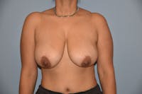 Breast Lift Before & After Gallery - Patient 92168028 - Image 1