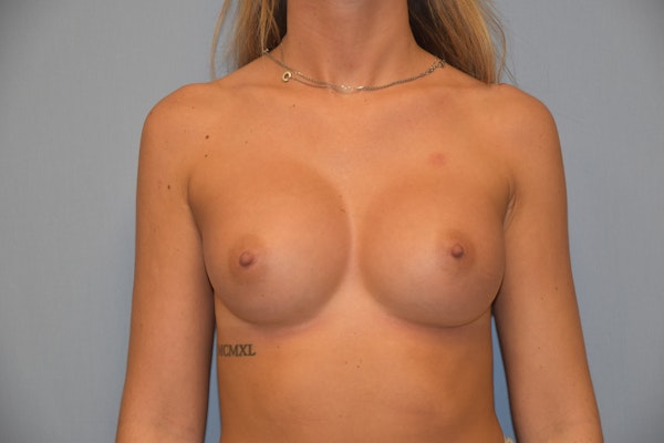 Breast Augmentation  Before & After Gallery - Patient 92167948 - Image 2