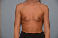 Breast Augmentation  Before & After Gallery - Patient 92167948 - Image 1
