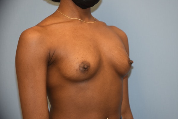 Breast Augmentation  Before & After Gallery - Patient 92151121 - Image 3