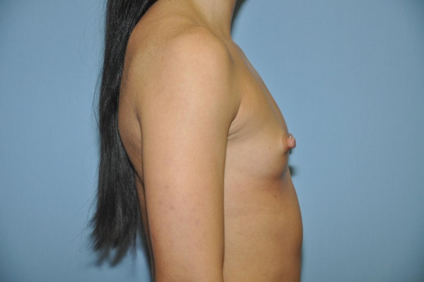 Breast Augmentation  Before & After Gallery - Patient 92142815 - Image 5