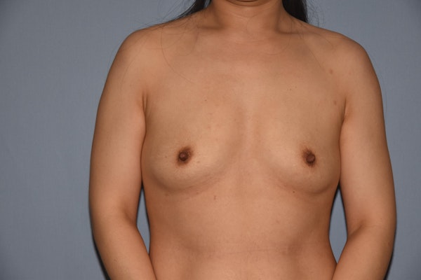Breast Augmentation  Before & After Gallery - Patient 92143030 - Image 1