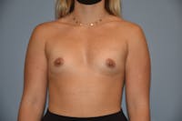 Breast Augmentation  Before & After Gallery - Patient 92139644 - Image 1