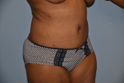 Tummy Tuck Before & After Gallery - Patient 92139516 - Image 4