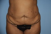 Tummy Tuck Before & After Gallery - Patient 92139516 - Image 1