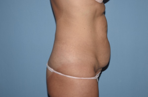 Tummy Tuck Before & After Gallery - Patient 92122674 - Image 5