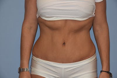 Tummy Tuck Before & After Gallery - Patient 92122674 - Image 2