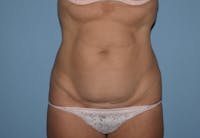 Tummy Tuck Before & After Gallery - Patient 92122674 - Image 1