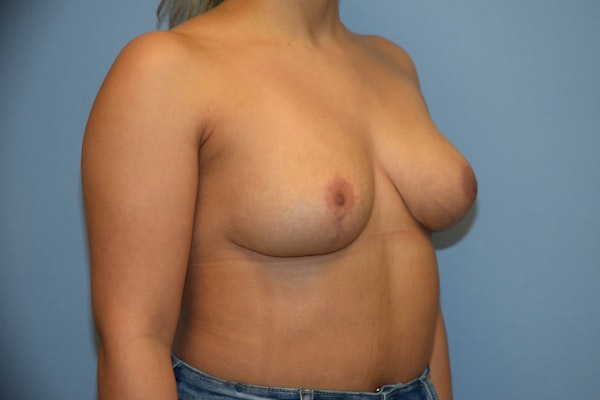 Breast Reduction Before & After Gallery - Patient 40628821 - Image 4