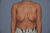 Breast Reduction Before & After Gallery - Patient 40628821 - Image 1