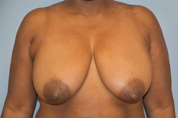 Breast Reduction Before & After Gallery - Patient 122906872 - Image 1