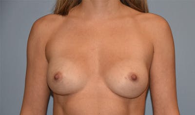 Breast Reduction Before & After Gallery - Patient 145355408 - Image 2