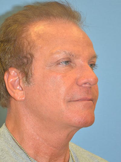 Facelift Before & After Gallery - Patient 122902615 - Image 4