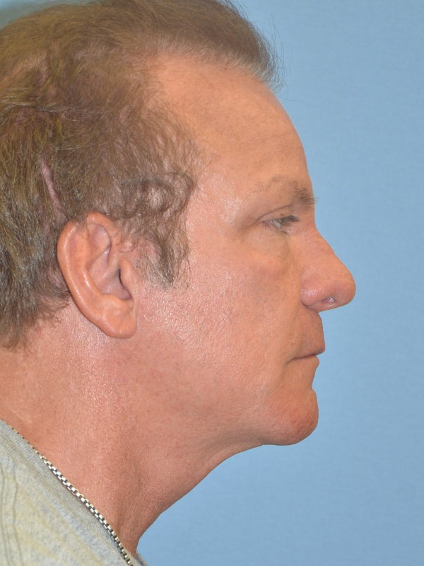 Facelift Before & After Gallery - Patient 122902615 - Image 6