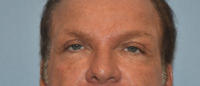 Eyelid Lift Before & After Gallery - Patient 122906503 - Image 2