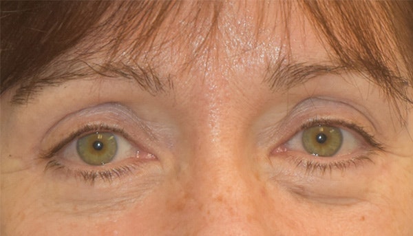 Eyelid Lift Before & After Gallery - Patient 142466208 - Image 1
