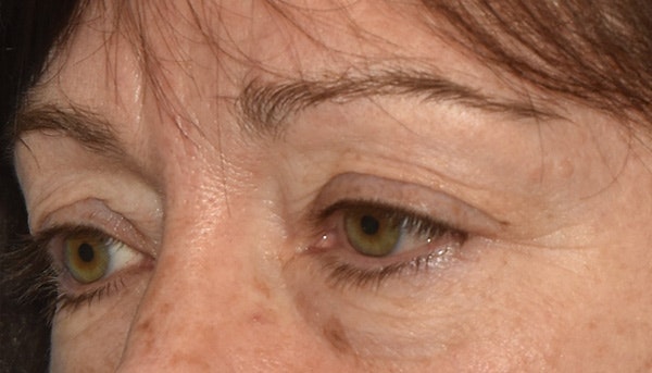 Eyelid Lift Before & After Gallery - Patient 142466208 - Image 3