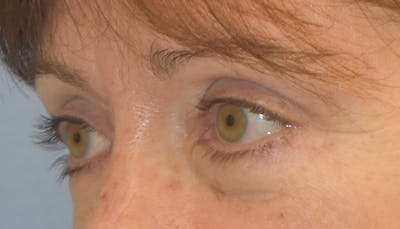 Eyelid Lift Before & After Gallery - Patient 142466208 - Image 4