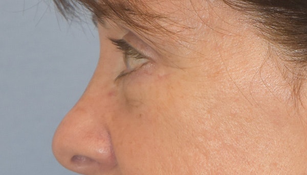 Eyelid Lift Before & After Gallery - Patient 142466208 - Image 6