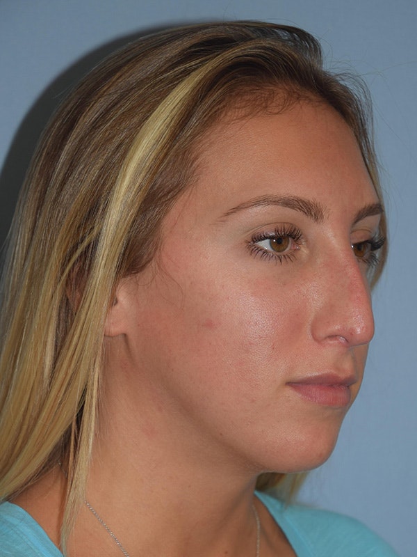 Rhinoplasty Before & After Gallery - Patient 145104053 - Image 5