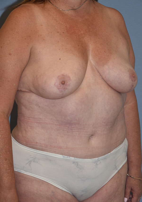 Mommy Makeover Before & After Gallery - Patient 122888398 - Image 4