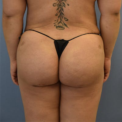 Brazilian Butt Lift Before & After Gallery - Patient 143772975 - Image 2
