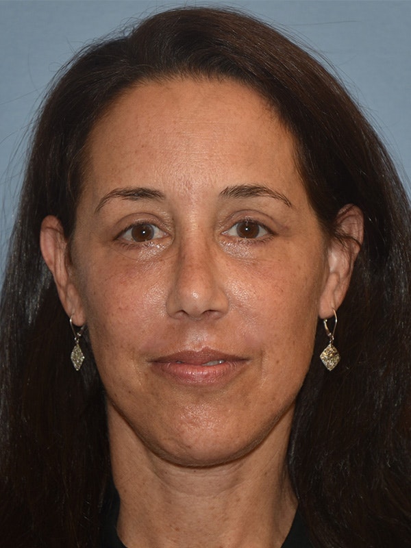 Facelift Before & After Gallery - Patient 143262821 - Image 2