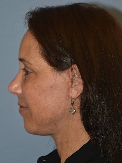 Facelift Before & After Gallery - Patient 143262821 - Image 6