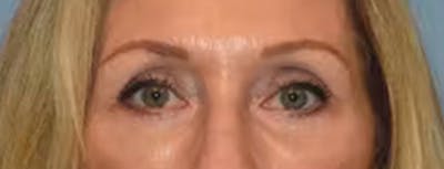 Eyelid Lift Before & After Gallery - Patient 40625811 - Image 2