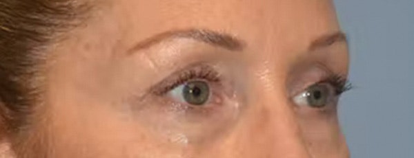 Eyelid Lift Before & After Gallery - Patient 40625811 - Image 3